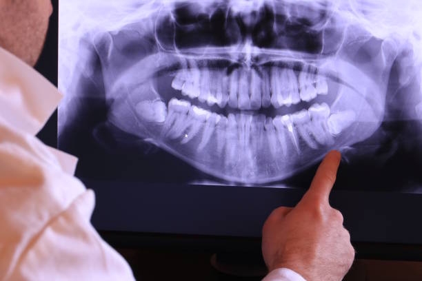 Best Emergency Wisdom Teeth Removal in Wilmington, NC